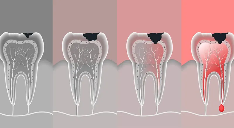 درد عصب کشی دندان