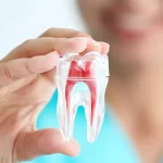درمان ریشه دندان در سازمان برنامه