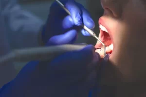 عوارض عصب کشی دندان