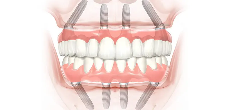 ایمپلنت با دندان مصنوعی