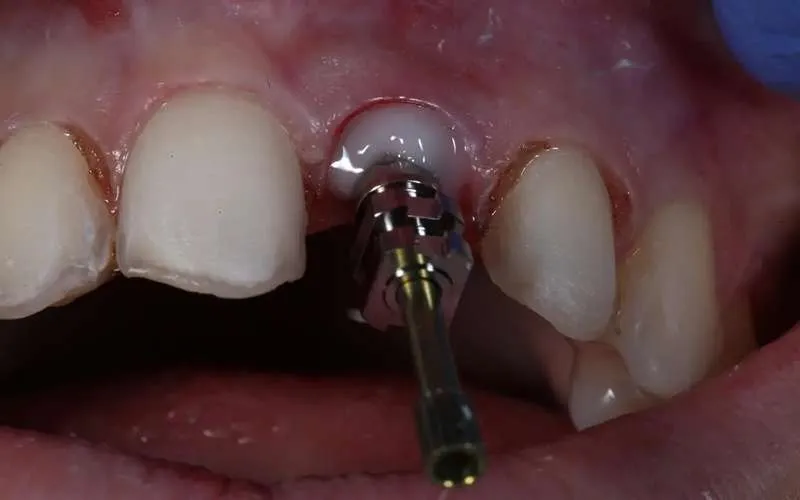 عکس ایمپلنت دندان جلو 2