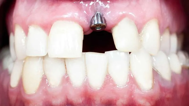عکس ایمپلنت دندان جلو 3