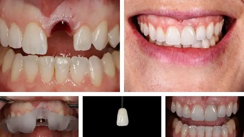 عکس ایمپلنت دندان جلو 4