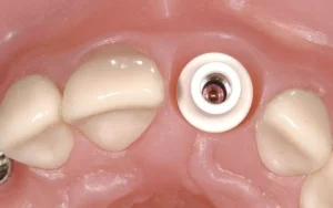 ایمپلنت دندان به روش پانچ