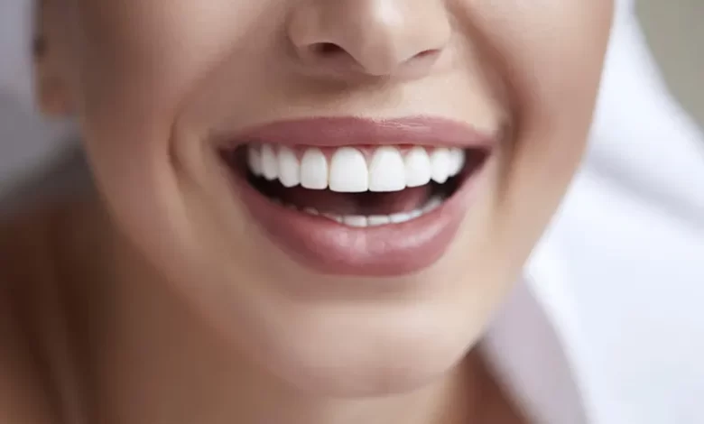 لمینت دندان