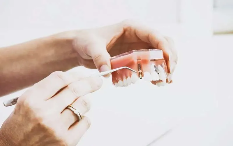مراحل ایمپلنت دندان تصویری