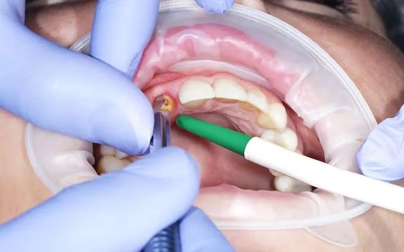 عکس مراحل ایمپلنت دندان
