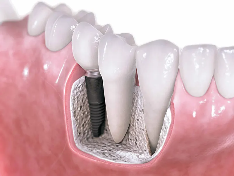 Advantages of dental implants