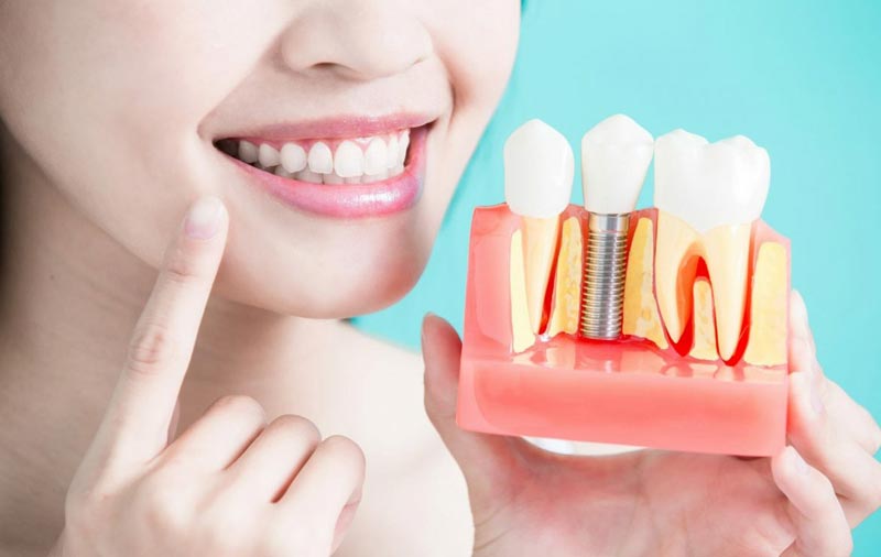 تفاوت بریج و ایمپلنت در کاشت دندان طبیعی
