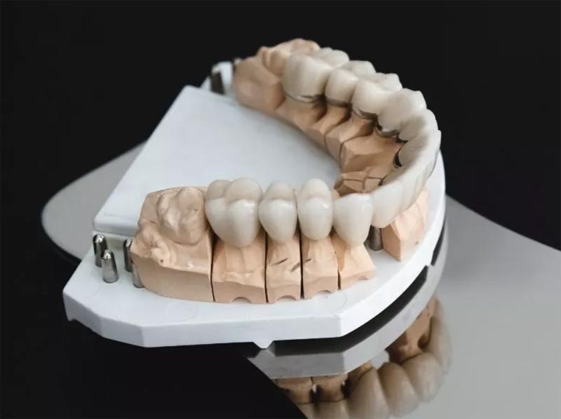 نحوه ساخت روکش دندان زیرکونیا