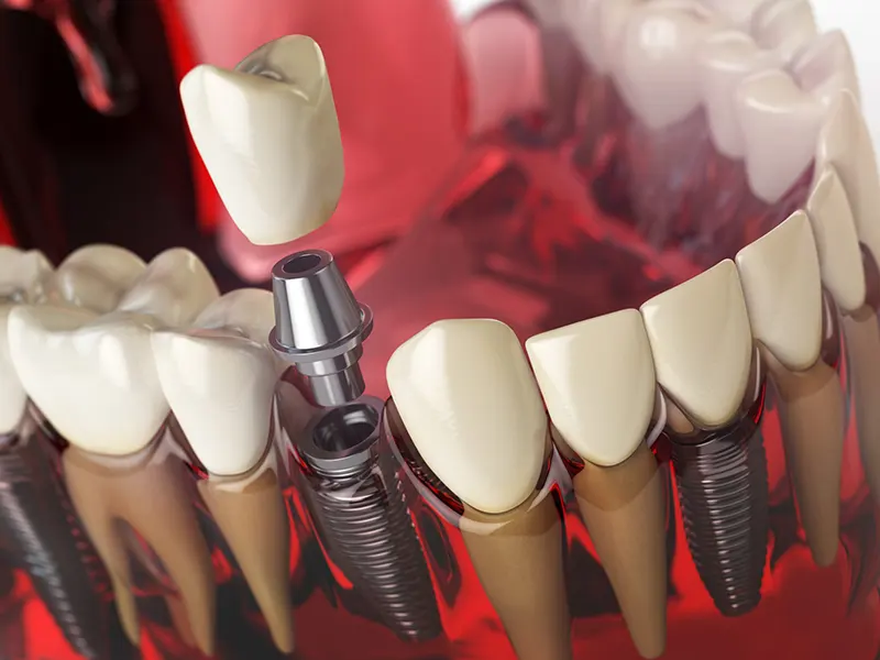 مراحل ایمپلنت دندان بدون جراحی