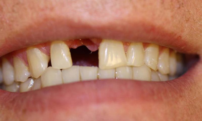 4 راه جلوگیری از پوسیدگی دندان
