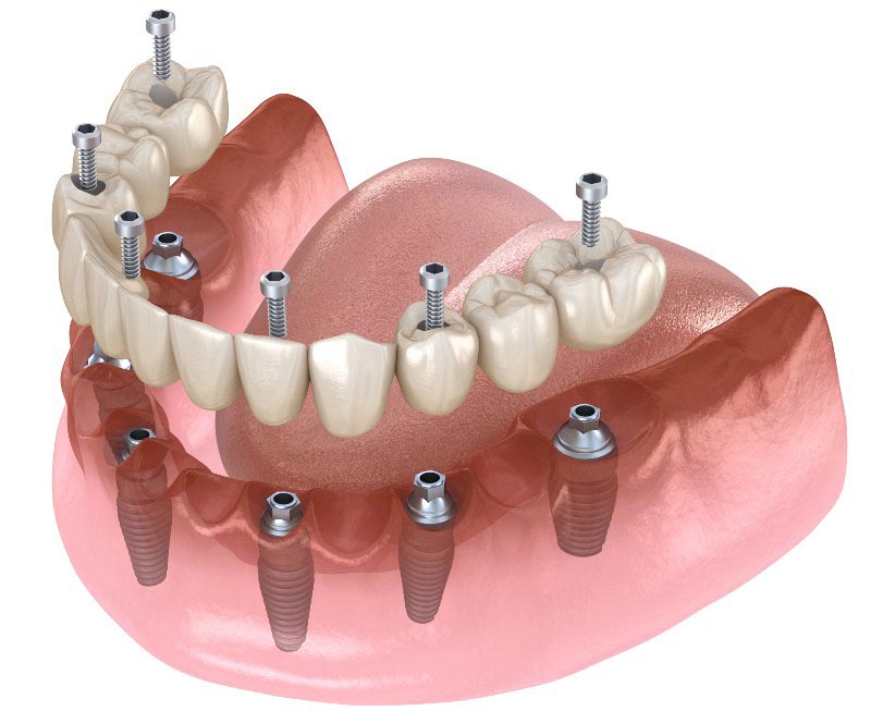 عوامل موثر بر هزینه پروتز دندان 