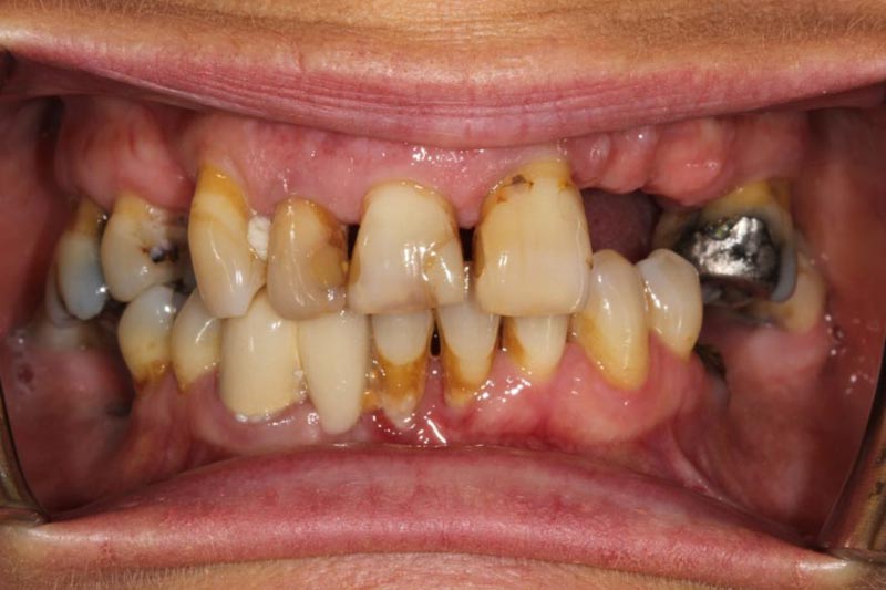  علائم پوسیدگی دندان