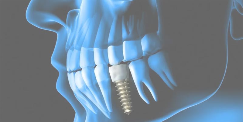 شرایط برای انجام ایمپلنت دندان