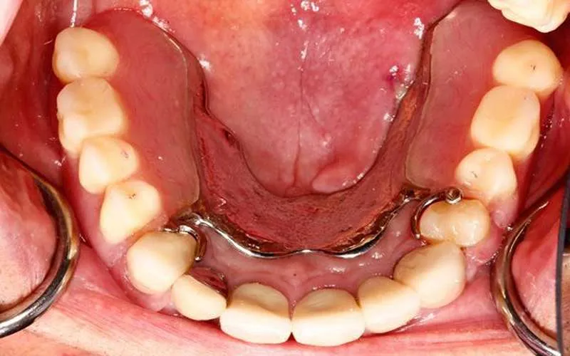 عکس پروتز دندان متحرک 3