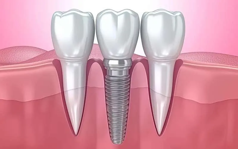 ایمپلنت دندان اسیاب