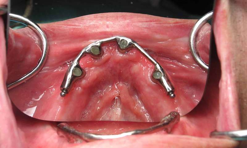 Subprio steel dental implant