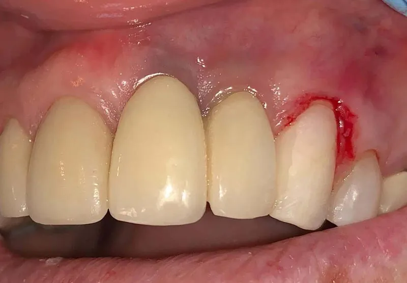 حساسیت به ایمپلنت دندان