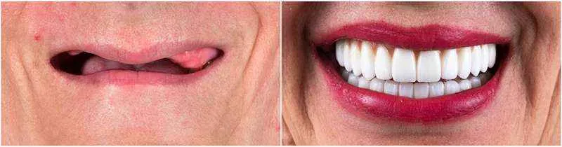 ایمپلنت دندان نمونه کار