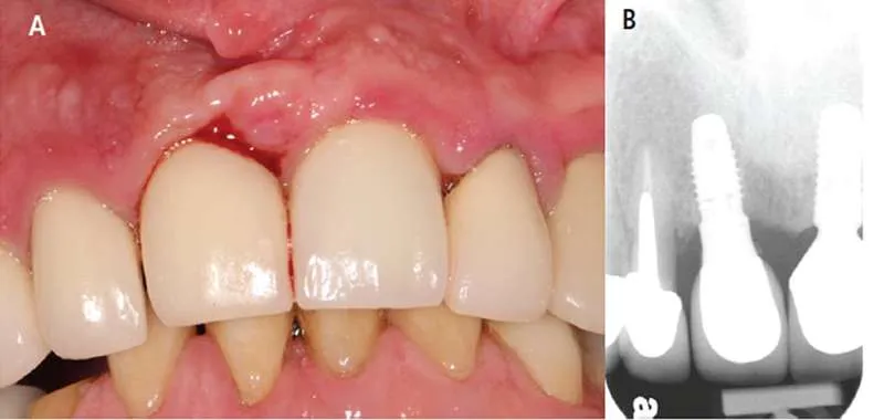 علايم عفونت ايمپلنت دندان