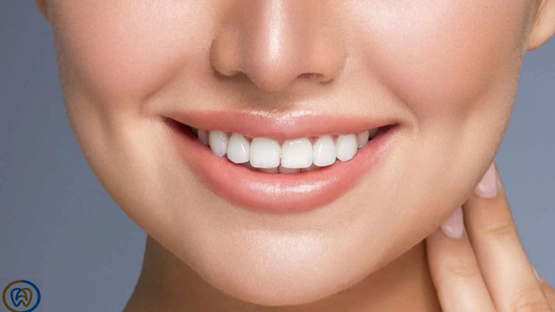هزینه لمینت دندان