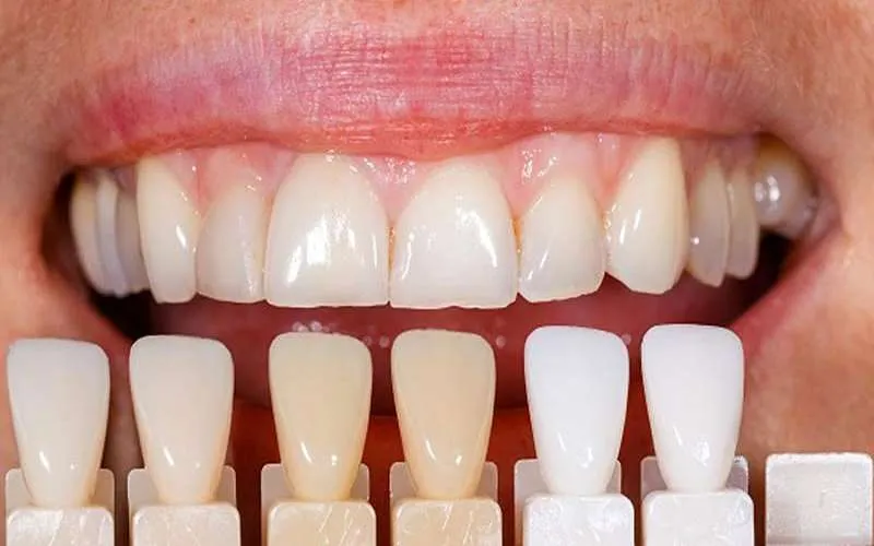 کاربردهای رایج بریج دندان