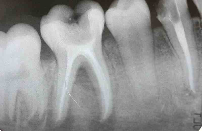 شرایط پس از درمان ریشه دندان در تهران