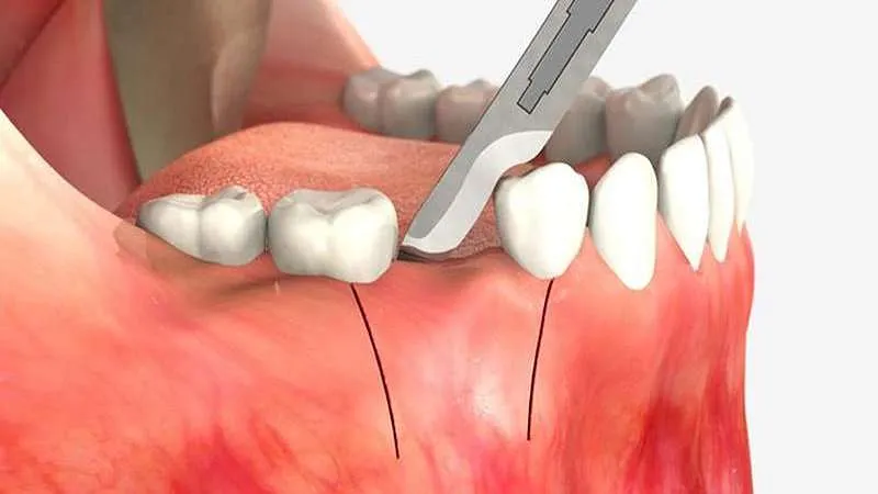عکس جراحی سینوس لیفت