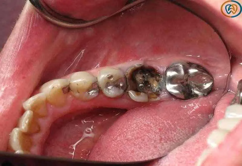  درمان مجدد دندان ها با عصب کشی 