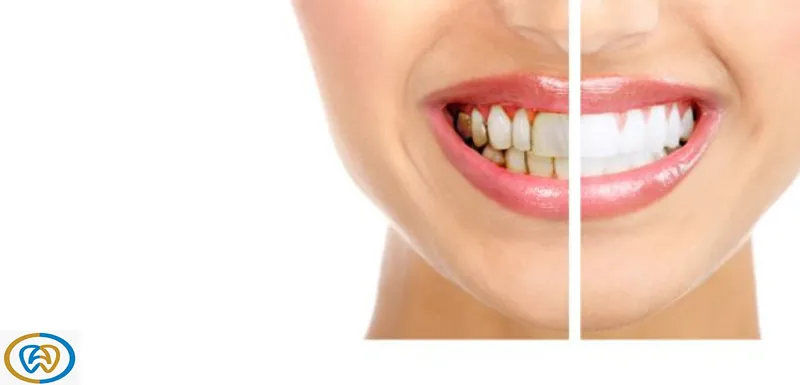 عکس انواع لمینت دندان