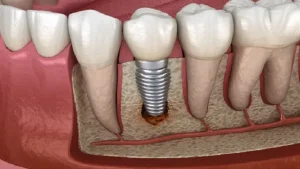 آبسه پری ایمپلنت (Peri-implant Abscess) چیست؟