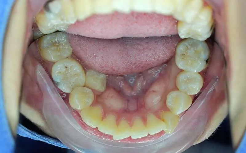 Gum abscess after dental implant