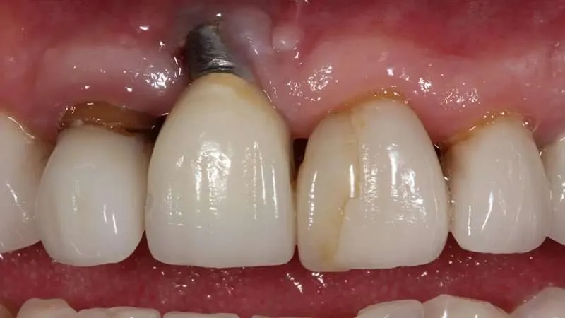 Gum whitening after implant