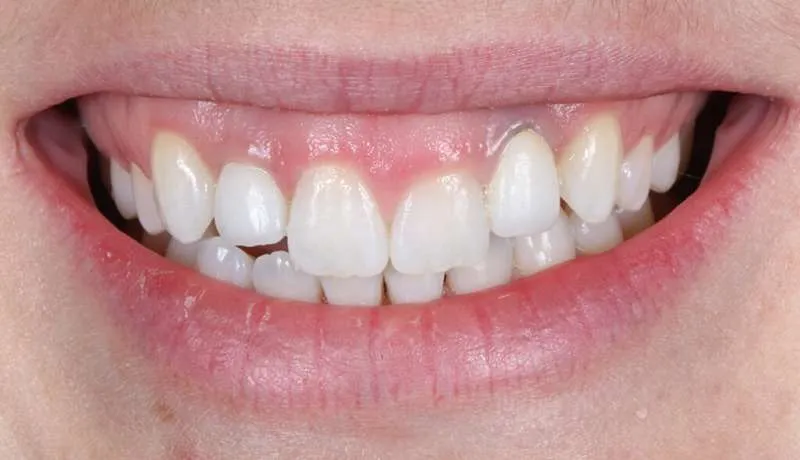 عکس دندان فرد مبتلا به سفیدی لثه