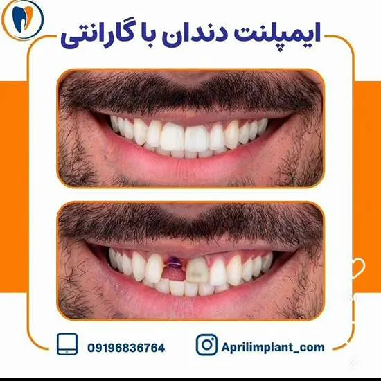 
ایمپلنت دندان بدون جراحی در تهرانپارس 1