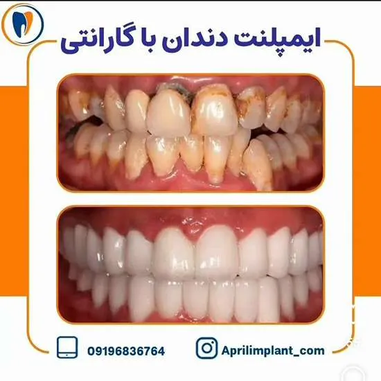 ایمپلنت دندان بدون جراحی در تهرانپارس 2