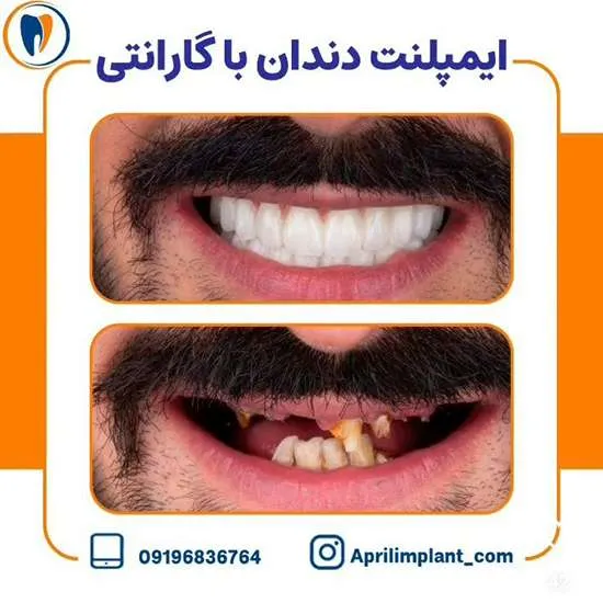 عکس نمونه کار ایمپلنت دندان 2