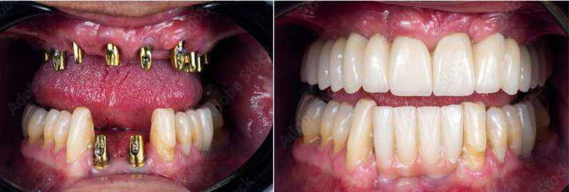 نمونه کار ایمپلنت دندان 2