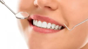 بلیچینگ دندان