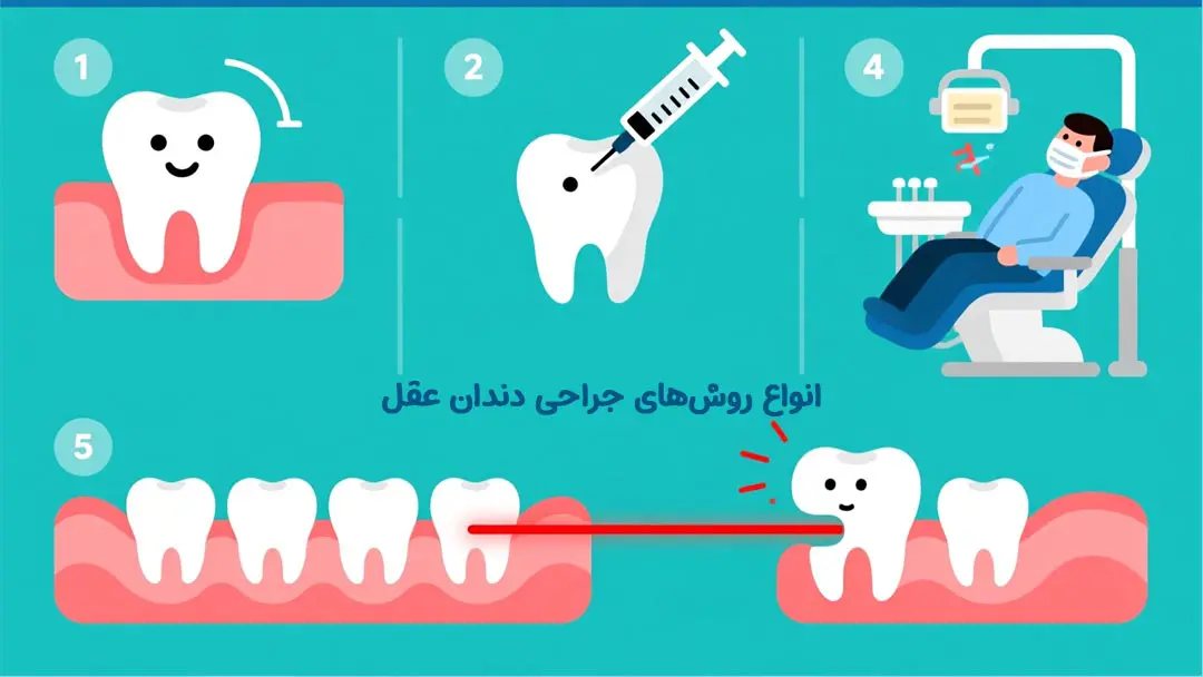 انواع روش‌های جراحی دندان عقل