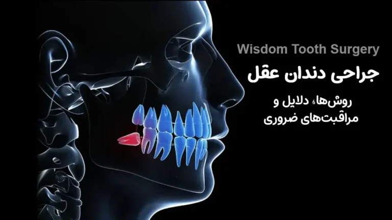 دندان عقل