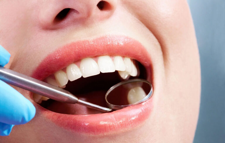 افتادن کامپوزیت دندان چگونه اتفاق می‌افتد؟ علت‌ آن چیست؟