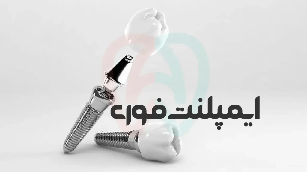 ایمپلنت فوری