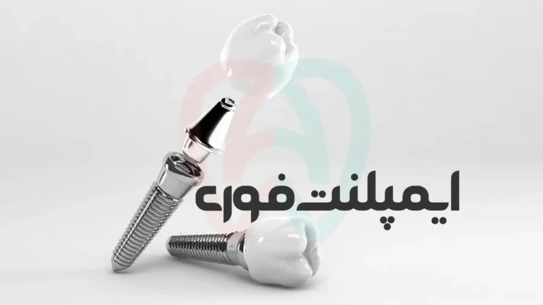 ایمپلنت فوری