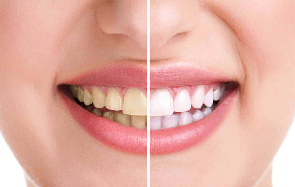 علت زرد شدن دندان چیست؟