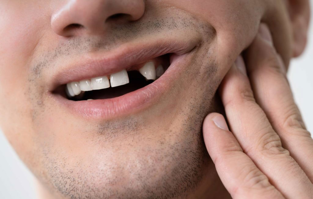 مراقبت‌های لازم بعد از ترمیم دندان شکسته با کامپوزیت