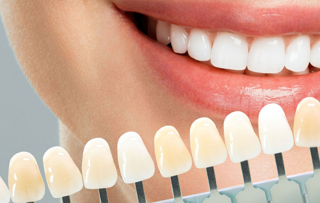 چه زمانی روکش؟ چه زمانی کامپوزیت را انتخاب کنیم؟