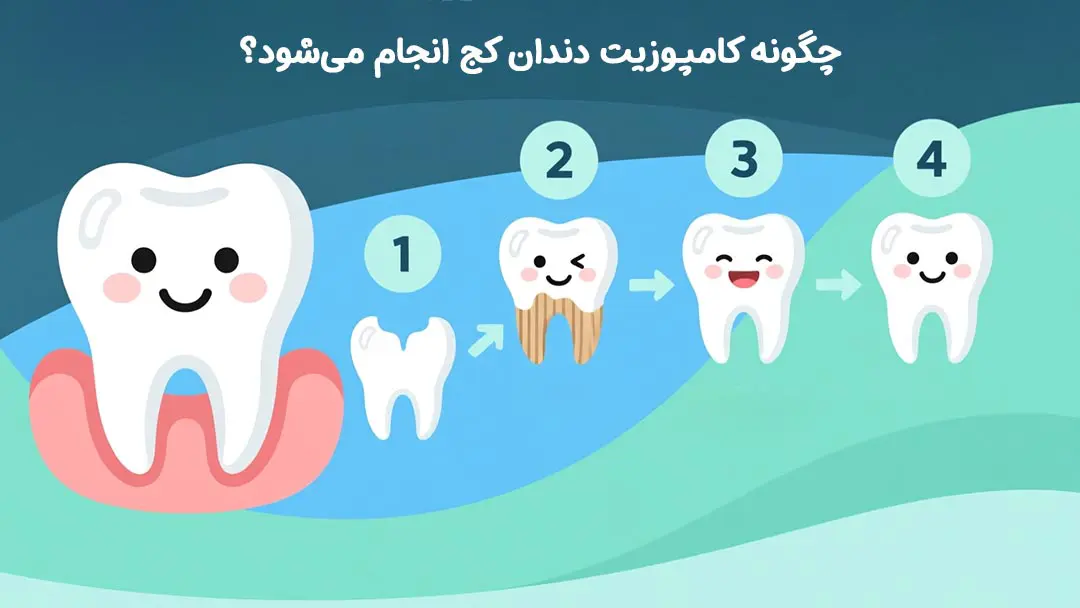 چگونه کامپوزیت دندان کج انجام می‌شود؟
