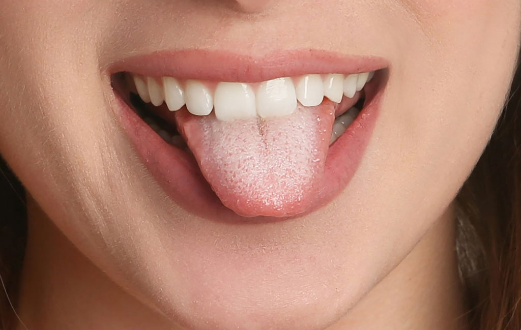 چگونه می‌توان سفیدی زبان را درمان یا پیشگیری کرد؟